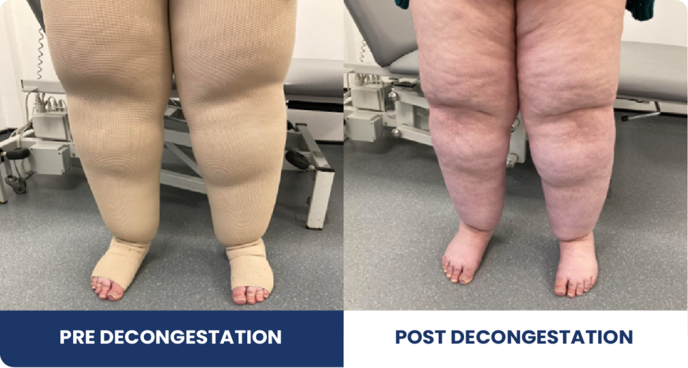 Conditions Lipoedema Pioneer Lymphoedema conditions-lipoedema-pioneer-lymphoedema