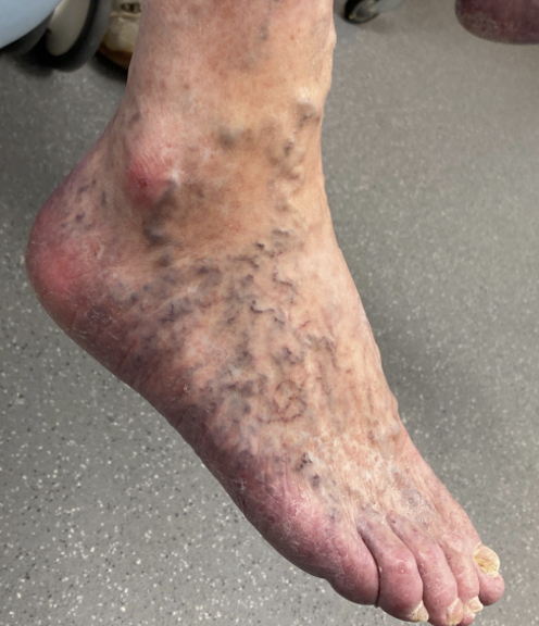 Photo-2-showing-spider-veins